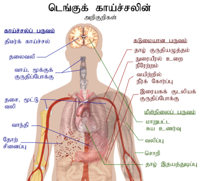400px Dengue fever symptoms tamil 1