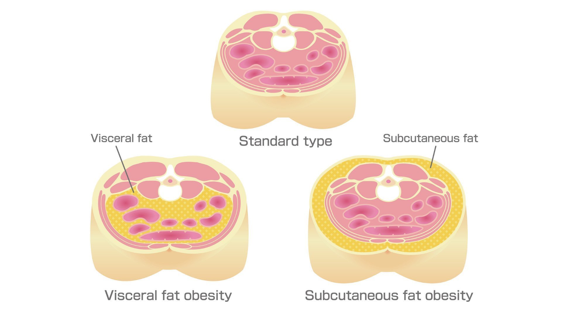 visceral fat and subcutaneous fat